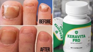 Keravita Pro Review: Ultimate Toxic Fungus Cleanse Up Formula